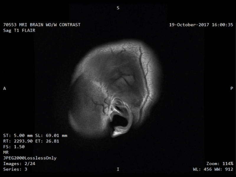 Gif of my brain MRI, showing sequential slices of the inside of my head in profile, looking left. Apparently it looks normal to doctors, what is abnormal is the electrical activity inside it!